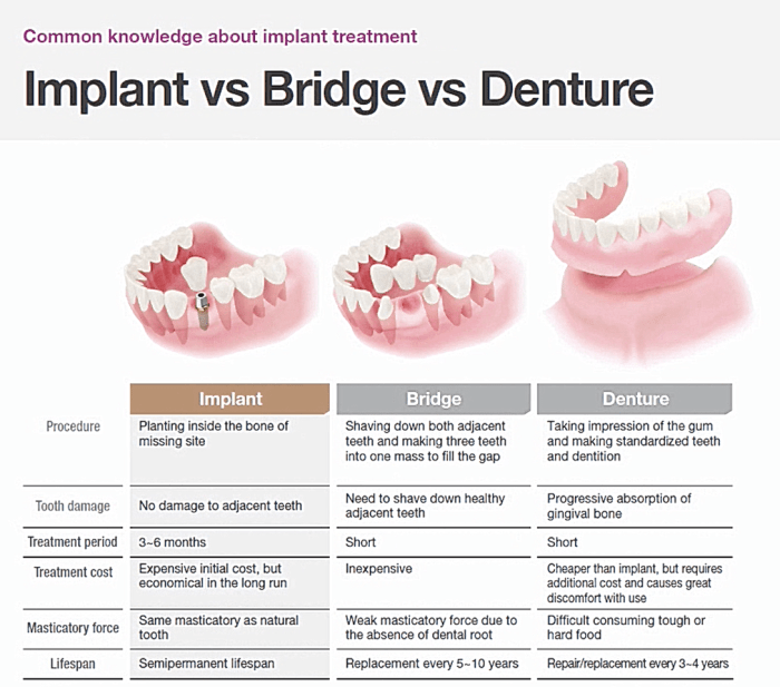 Denture implant difference
