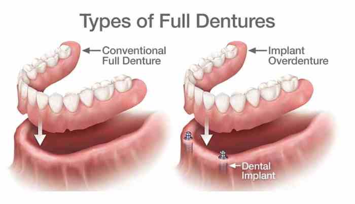Dental implants vs dentures